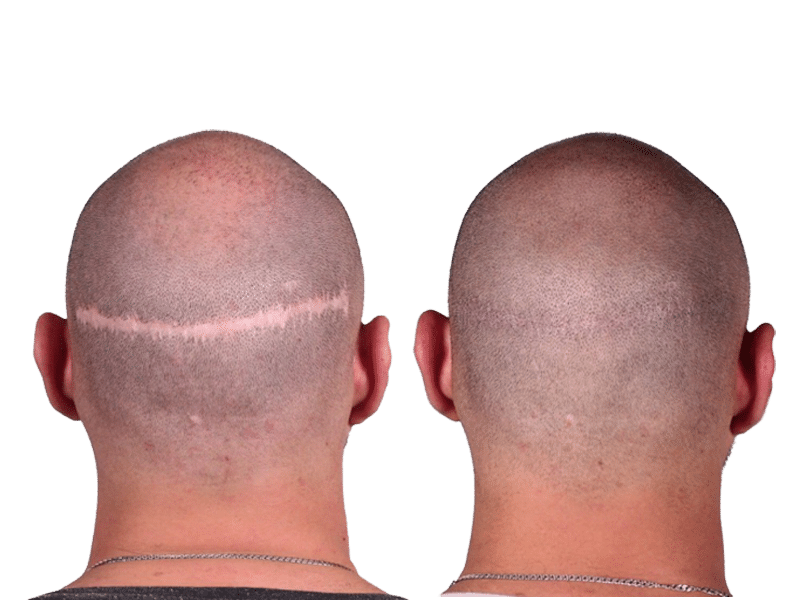 scalp micropigmentation scar camouflage procedure