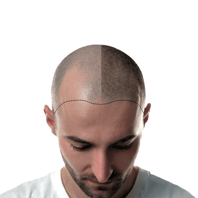 scalp tattoo