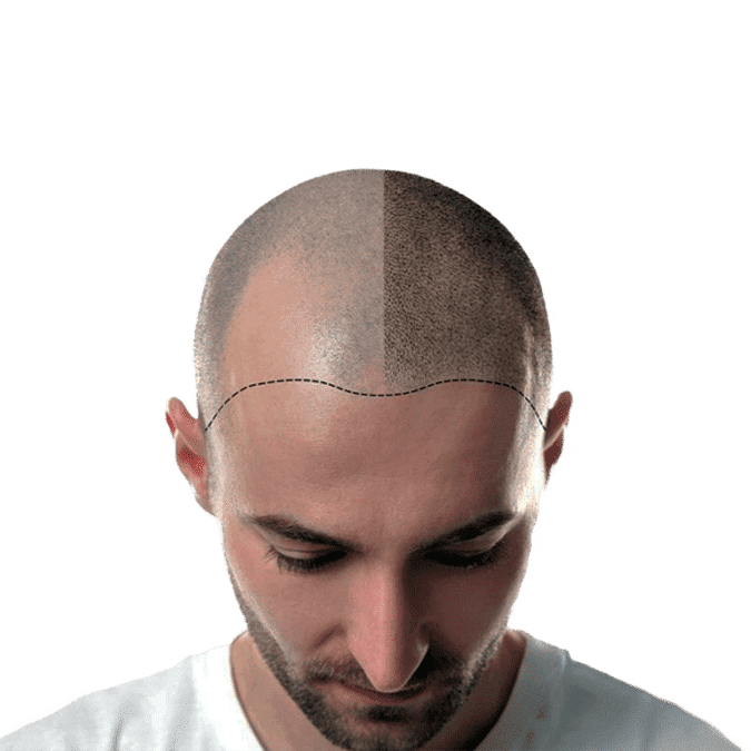 scalp micropigmentation halifax