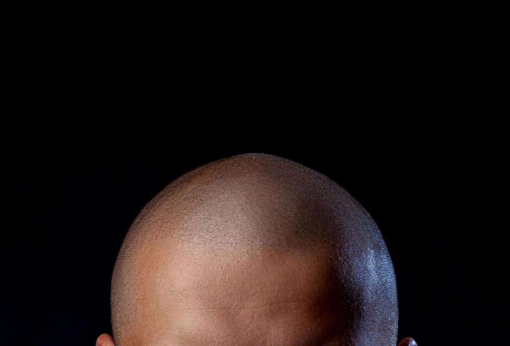 Microblading for Hair Loss: 5 Things to Know Before You Try It 1 Serious man with scalp micropigmentation3 scaled