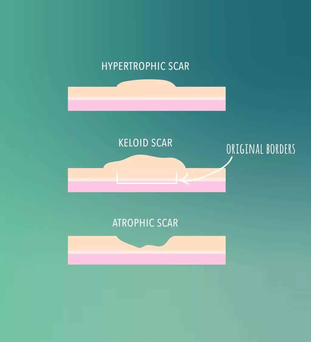 types of scars - healed