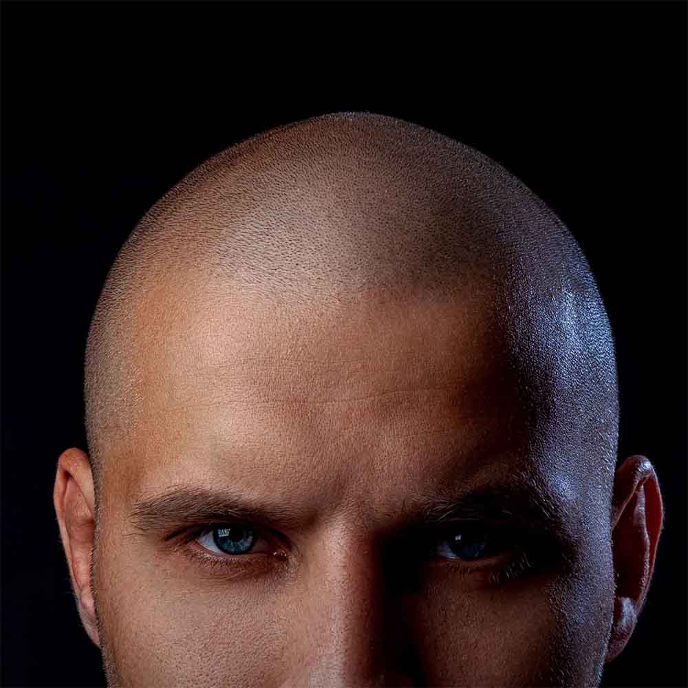 Serious man with scalp micropigmentation cropped SCALPS | Micropigmentation Centers
