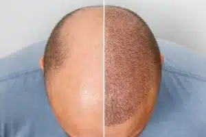 8 Powerful Reasons to Consider a Hair Tattoo for Hair Loss Confidence 4 hair transplant vs scalp micropigmentation