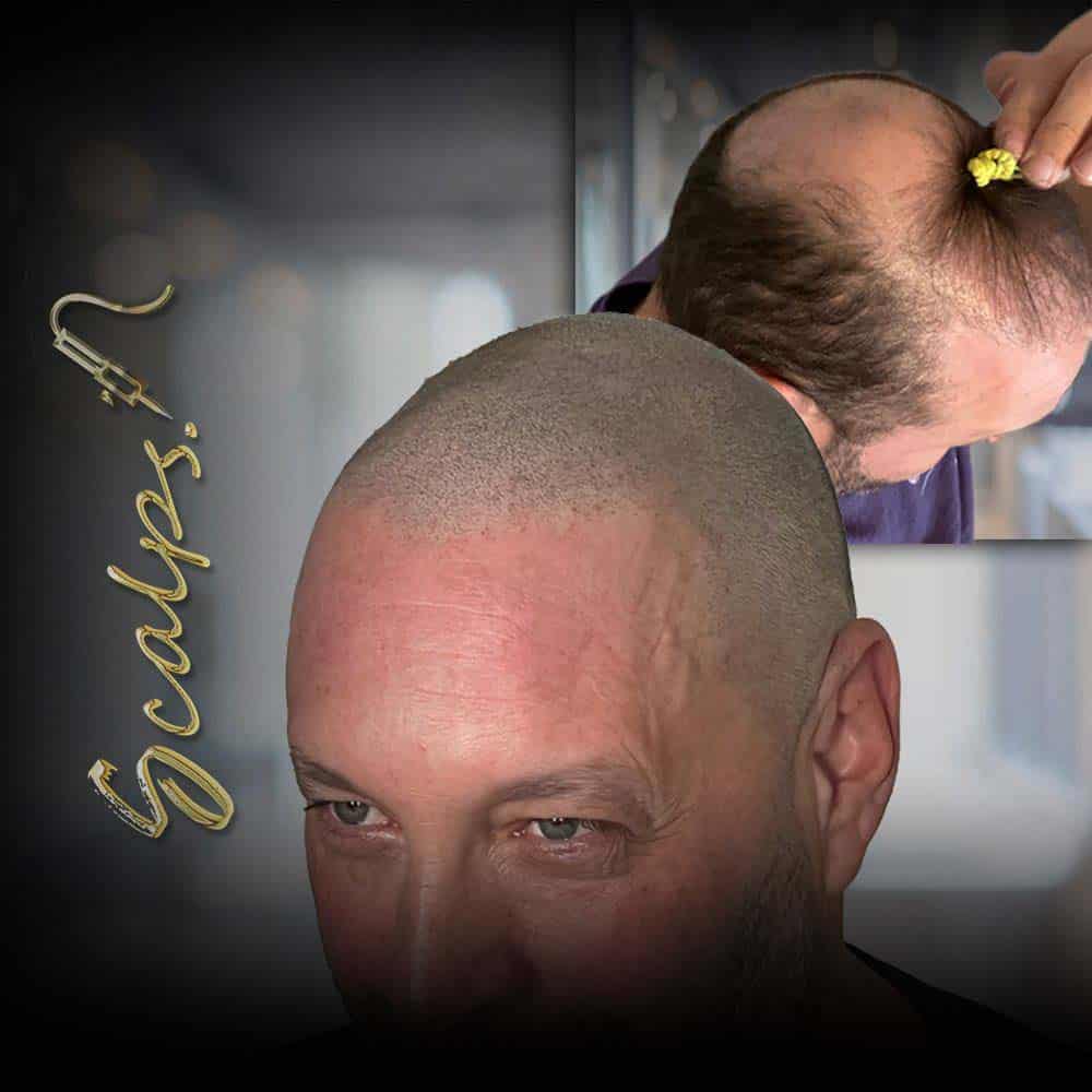 scalp micropigmentation before and after with beautiful result 1