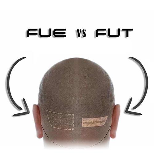 FUT-vs-FUT-SCARS