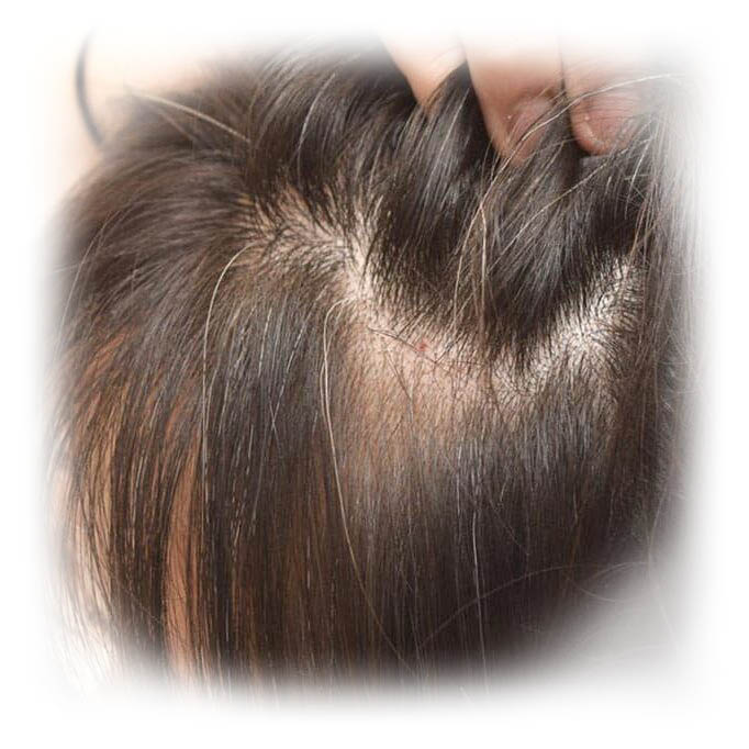 woman pulling hair back showing thinning hair in part