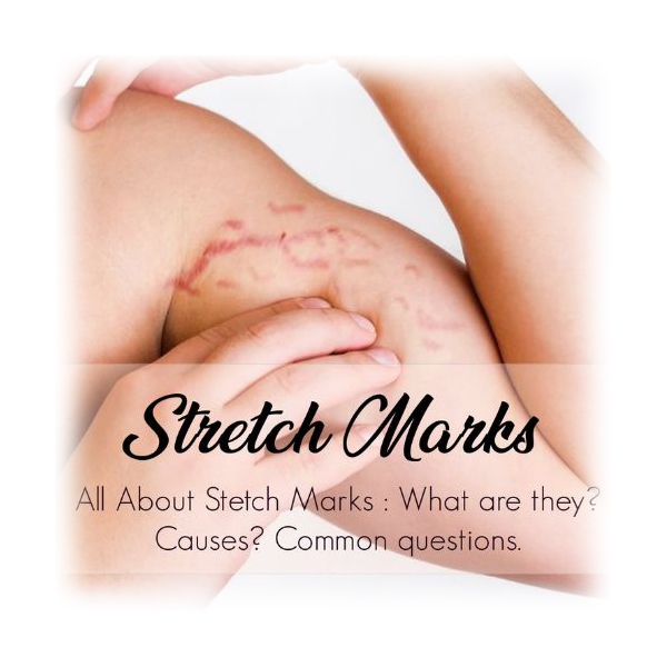 questions-about-stretch-marks-innrer-glow