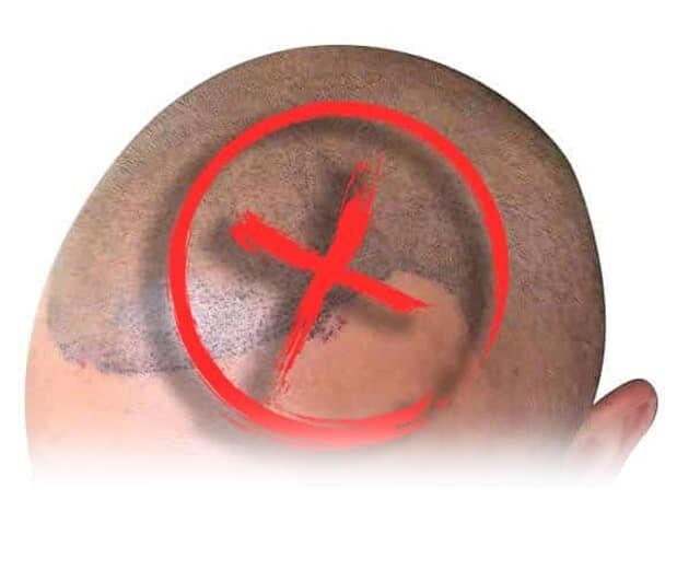 scalp-bad procedure smp