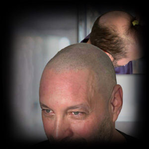 scalp micropigmentation-before-and-after for older man with natural results SMP