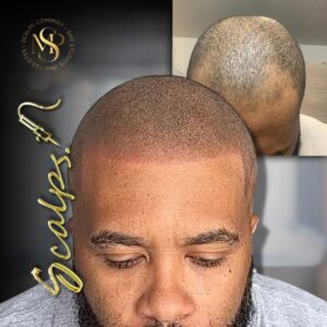 Semi defined hairline for a Norwood three client after a scalp Micropigmentation procedure. Done by Alex Asher from SCALPS USA in New Jersey