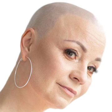 woman with smp with alopecia
