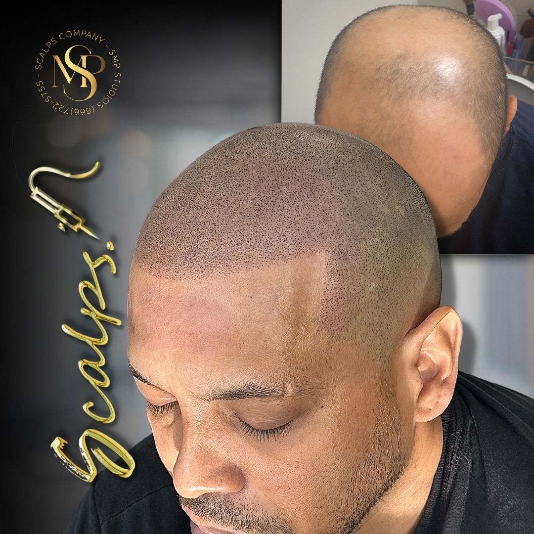 Very defined natural hairline for young male That was a Norwood 7 after a scalp micropigmentation procedure. Done by Alex Asher from SCALPS USA in New Jersey
