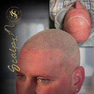 Beautiful natural result for a man with very light skin and very light hair With a norwood 7. done through scalp micropigmentation. Done by Alex Asher from SCALPS USA in New Jersey