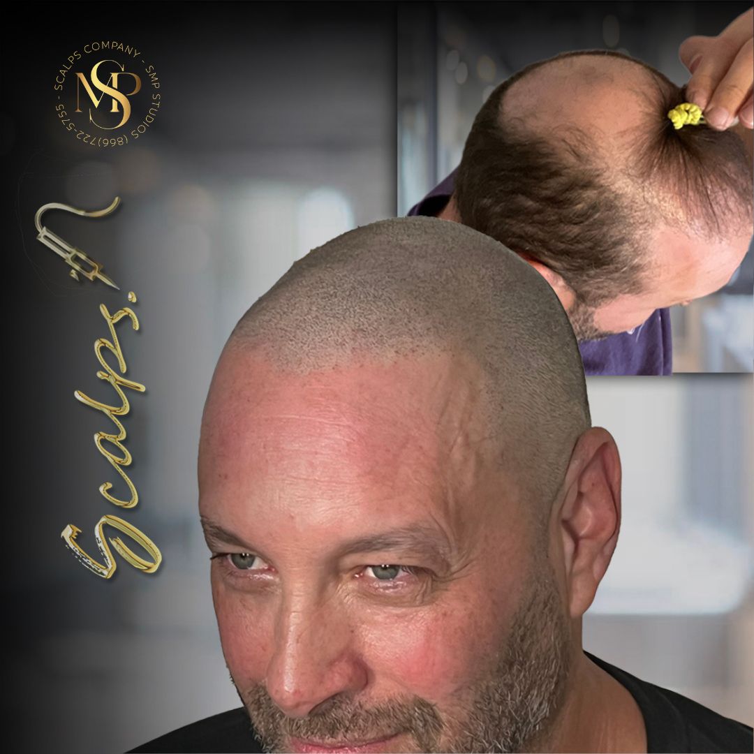 Beautiful natural result for older. man after scalp micropigmentation procedure. Beautiful natural result on older white male, norwood 7 that received a scalp micropigmentation procedure. Done by Alex Asher from SCALPS USA in New Jersey