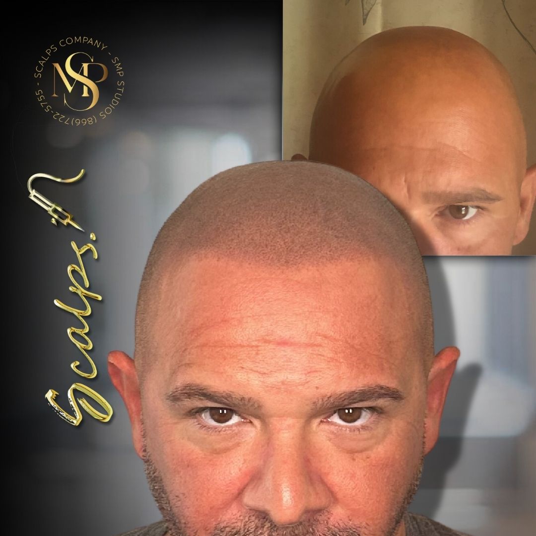 Natural curved hairline for Norwood 7 client after a scalp micropigmentation treatment. Done by Alex Asher from SCALPS USA in New Jersey
