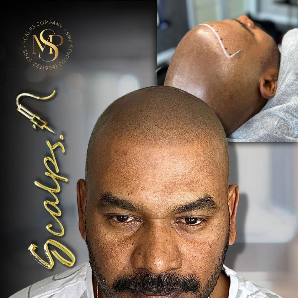 Beautiful natural result on older Indian male that received a scalp micropigmentation procedure. Done by Alex Asher from SCALPS USA in New Jersey