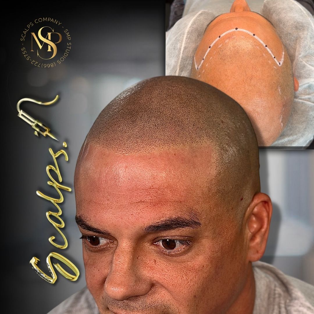 Gorgeous natural result for middle aged man that was a Norwood After a scalp micropigmentation procedure. Done by Alex Asher from SCALPS USA in New Jersey