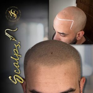 Norwood 7 client after a scalp micropigmentation procedure. procedure. with hyper realistic results. Done by Alex Asher from SCALPS USA in New Jersey