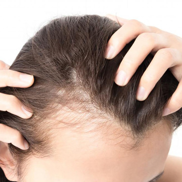 woman parting hair with hair loss