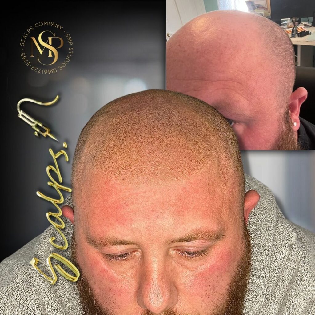 Round natural result form scalp. form scalp micropigmentation for. a light skin light hair men.Done by Alex Asher from SCALPS USA in New Jersey