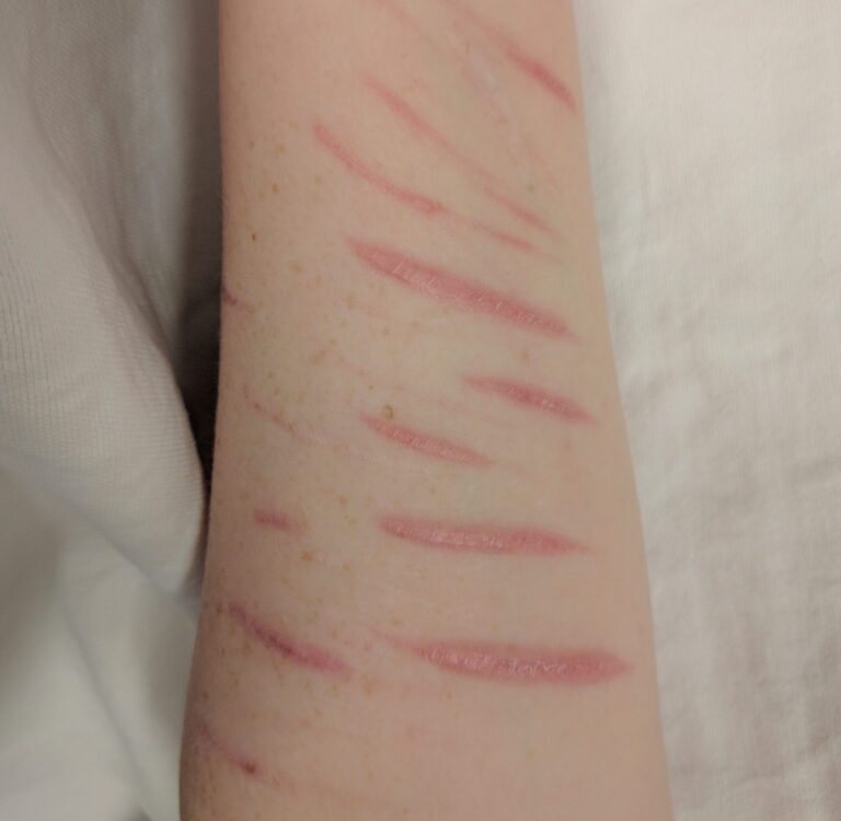 self inflicted scars