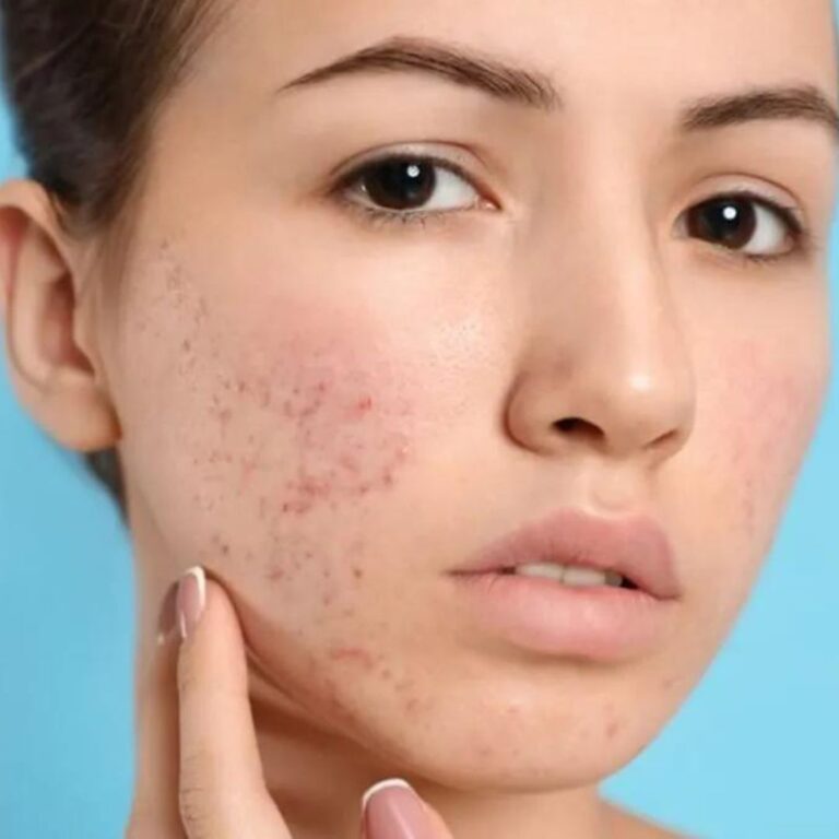 acne scar treatments with micropigmentation
