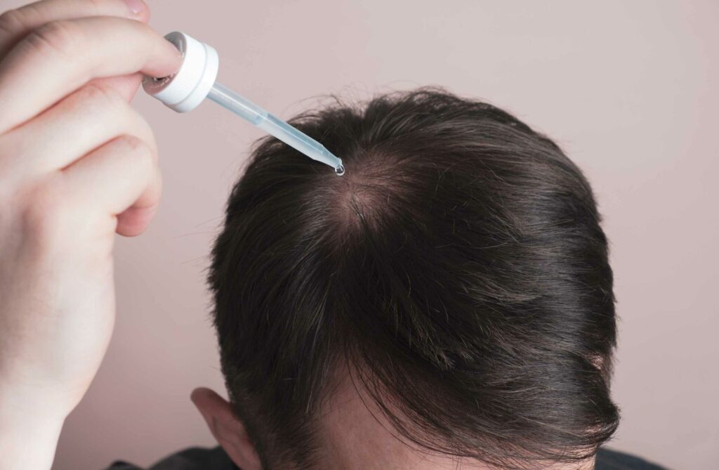 Does Testosterone, Finasteride, and Minoxidil Affect Scalp Micropigmentation