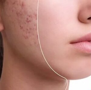 woman with acne scars before and after acne revision treatment