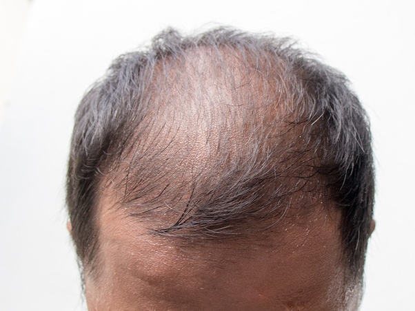 norwood 4 client with thin hair