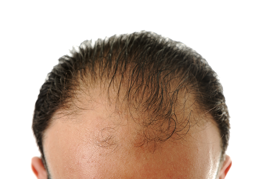 How Much Hair Loss Is Normal? Understanding Shedding vs. Serious Hair Loss 1 16213440262 ba52993238 o