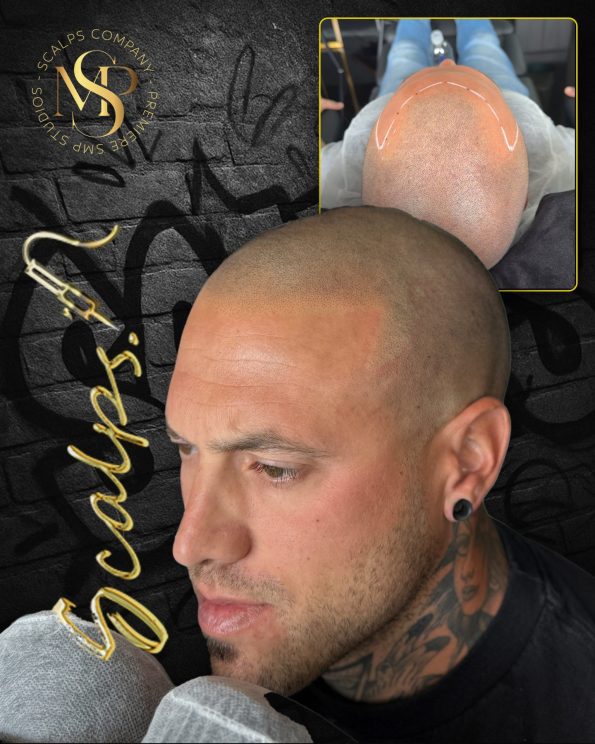 Scalp Micropigmentation & Hair Tattoo Studio In Manalapan NJ 15 SCALPS client scalp micropigmentation result