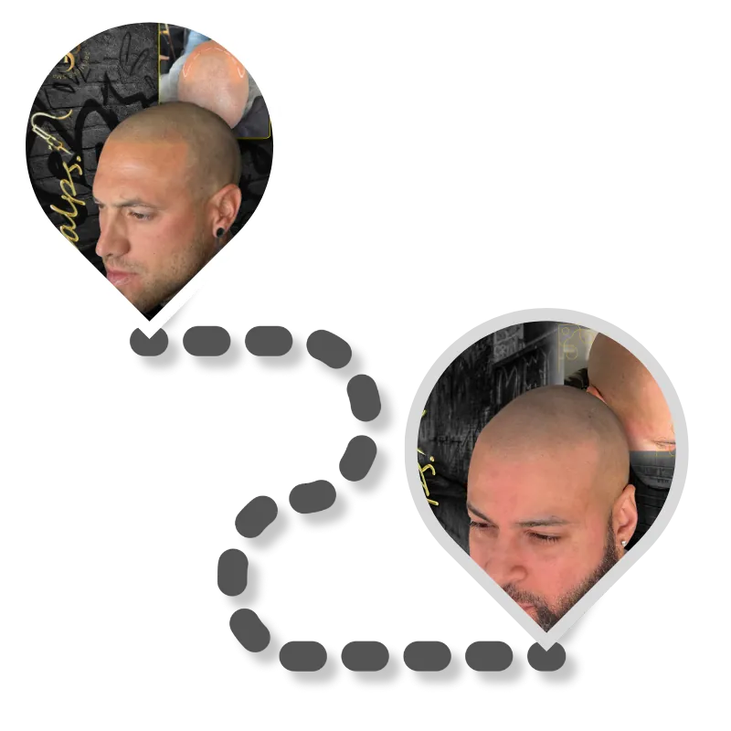 Scalp Micropigmentation Cost | SCALPS 7 map_with_smp_clients