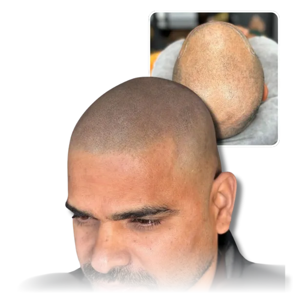 Scalp Micropigmentation & Hair Tattoo Studios | Scalps USA 5 SCALPS USA smp client with before after image