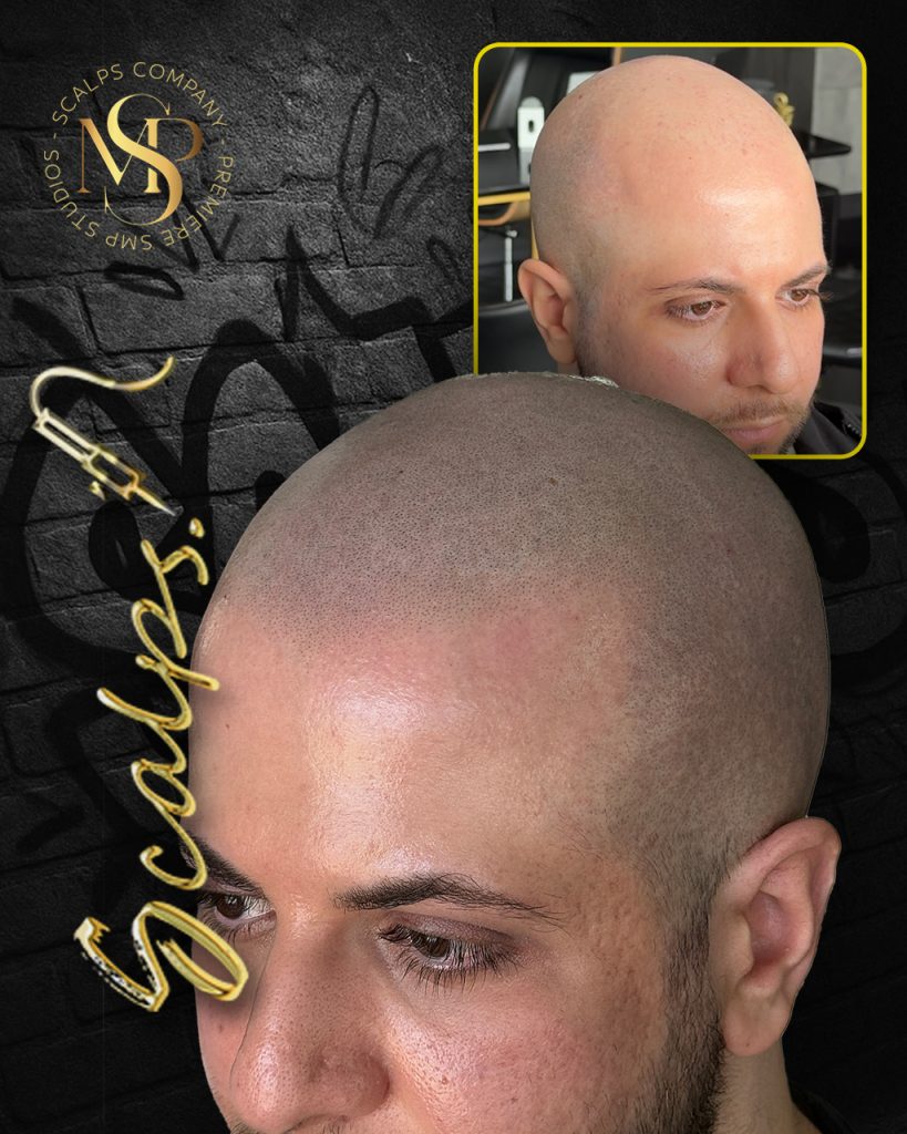 Before And Afters - SMP Gallery | SCALPS USA 1 Jordan G before & after scalp micropigmentation at SCALPS in Manalapan NJ - Alex Asher