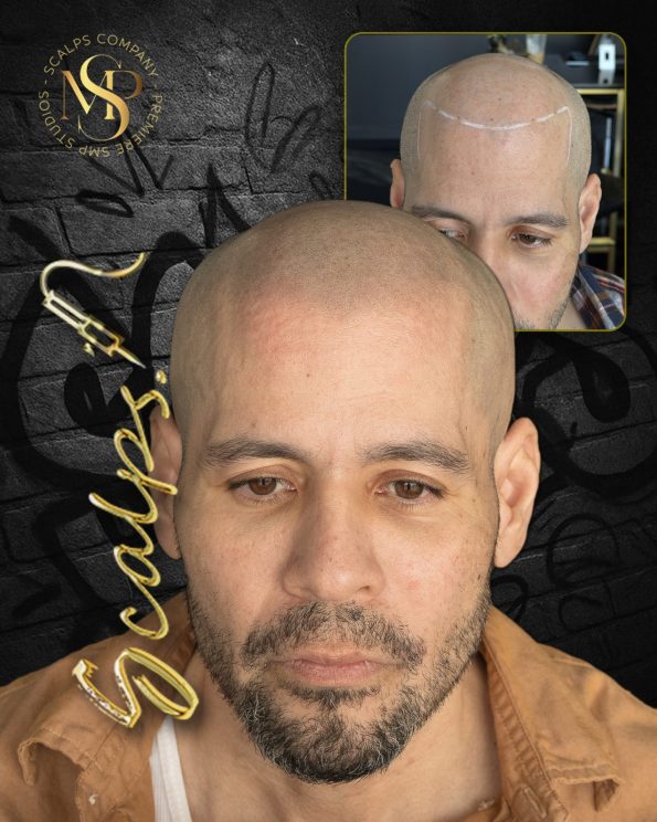 Scalp Micropigmentation & Hair Tattoo Studio In Manalapan NJ 13 Rafael S. scalp micropigmentation result