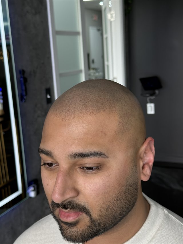 Book Micropigmentation Services | Scalps USA 1 Haris after scalp micropigmentation at SCALPS