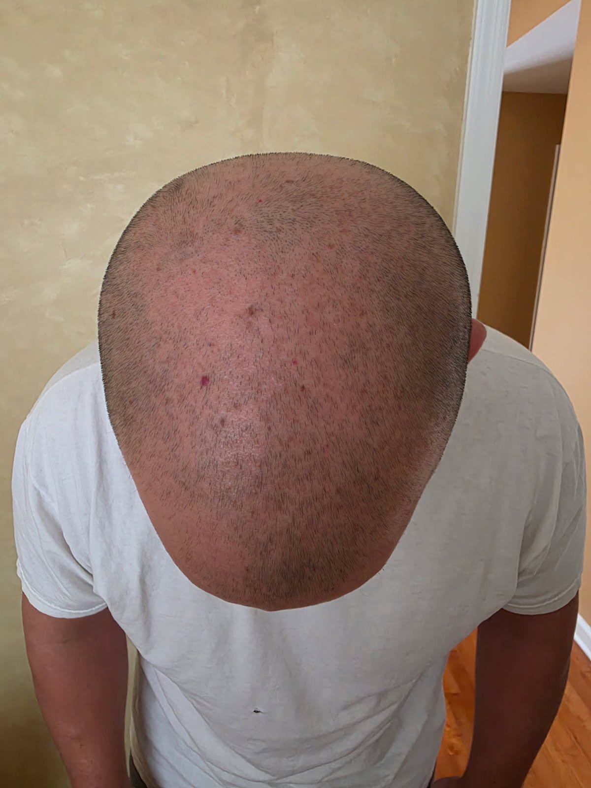 Scalp Micropigmentation & Hair Tattoo Studio In Manalapan NJ 4 Helder M. before scalp micropigmentation