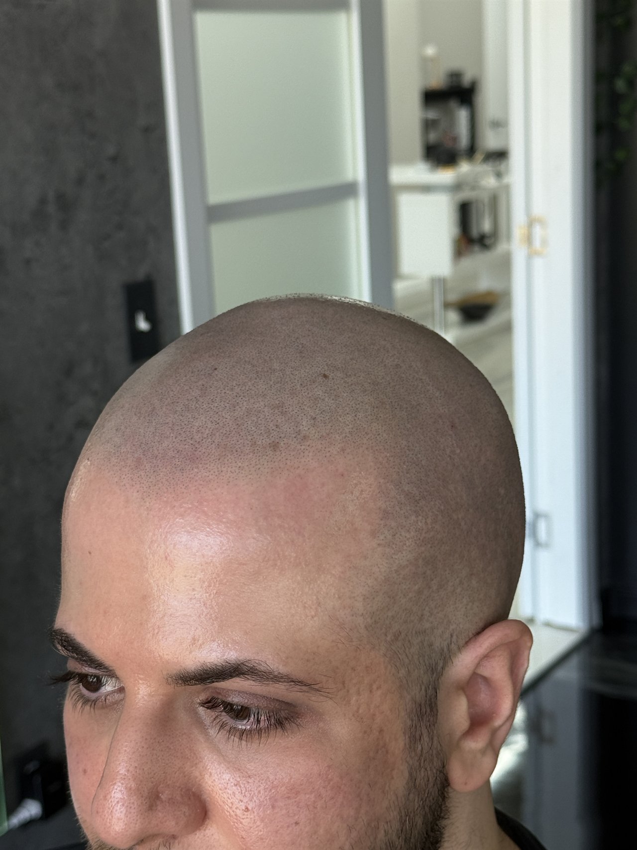 Scalp Micropigmentation Florida | SCALPS 3 Jordan G. after scalp micropigmentation