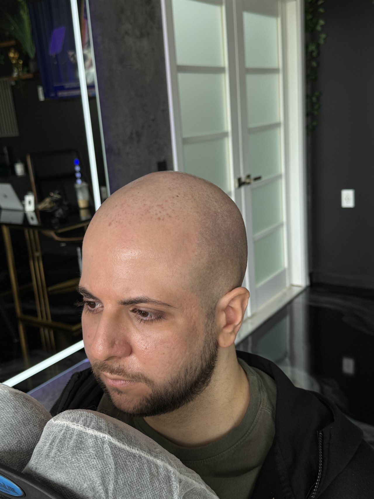 Scalp Micropigmentation & Hair Tattoo Studio In Manalapan NJ 2 Jordan G. before scalp micropigmentation