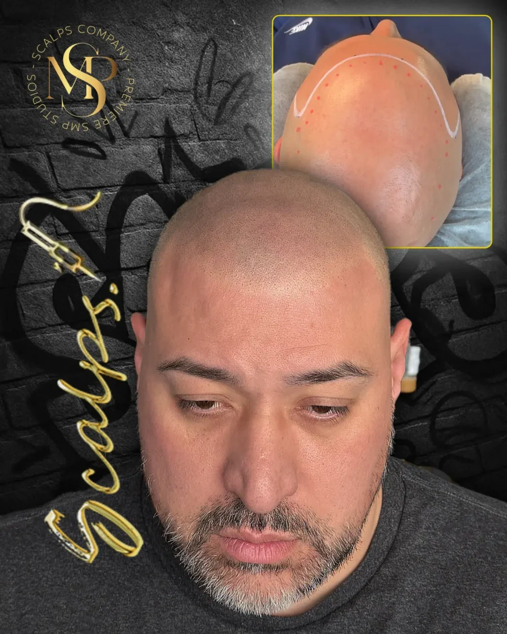Real SCALPS client before-and-after composite, front view, portfolio photograph 4