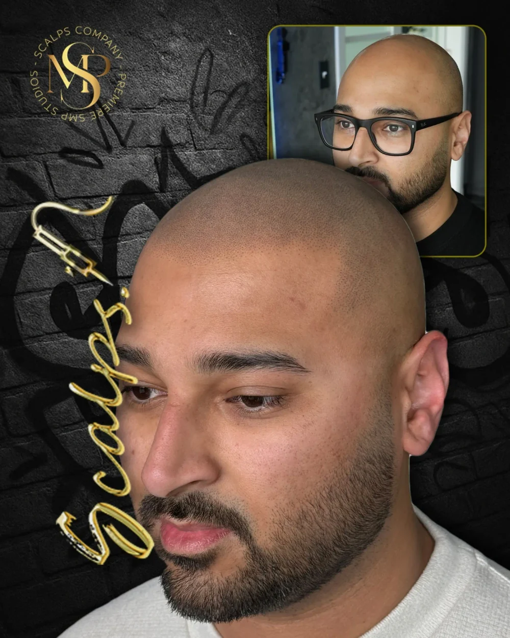 Real SCALPS client before-and-after composite, side view, portfolio photograph 1