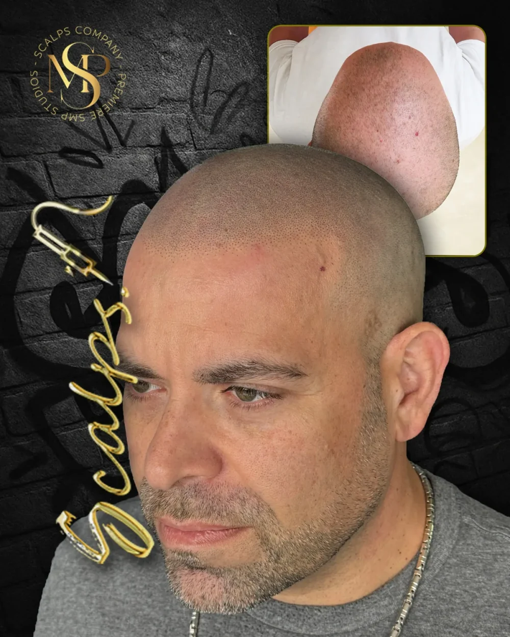 Real SCALPS client before-and-after composite, side view, portfolio photograph 2