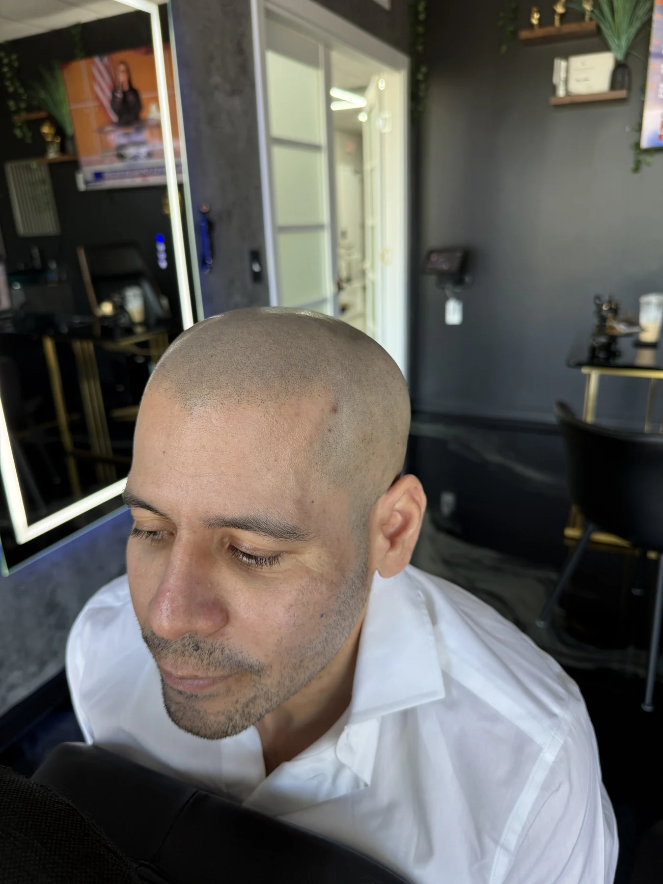 Left-angle view of Rafael’s healed SMP at 60 days