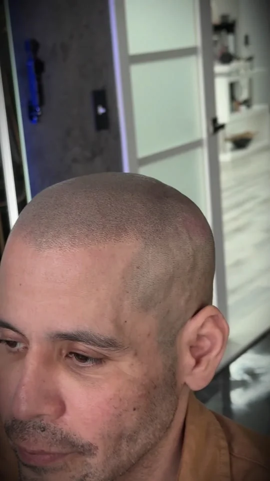 Close-up of Rafael’s fresh scalp micropigmentation