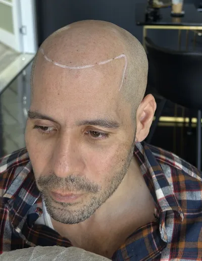 Rafael before SMP, with the proposed hairline drawn in white