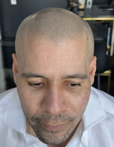 Rafael's scalp 60 days after his final SMP session