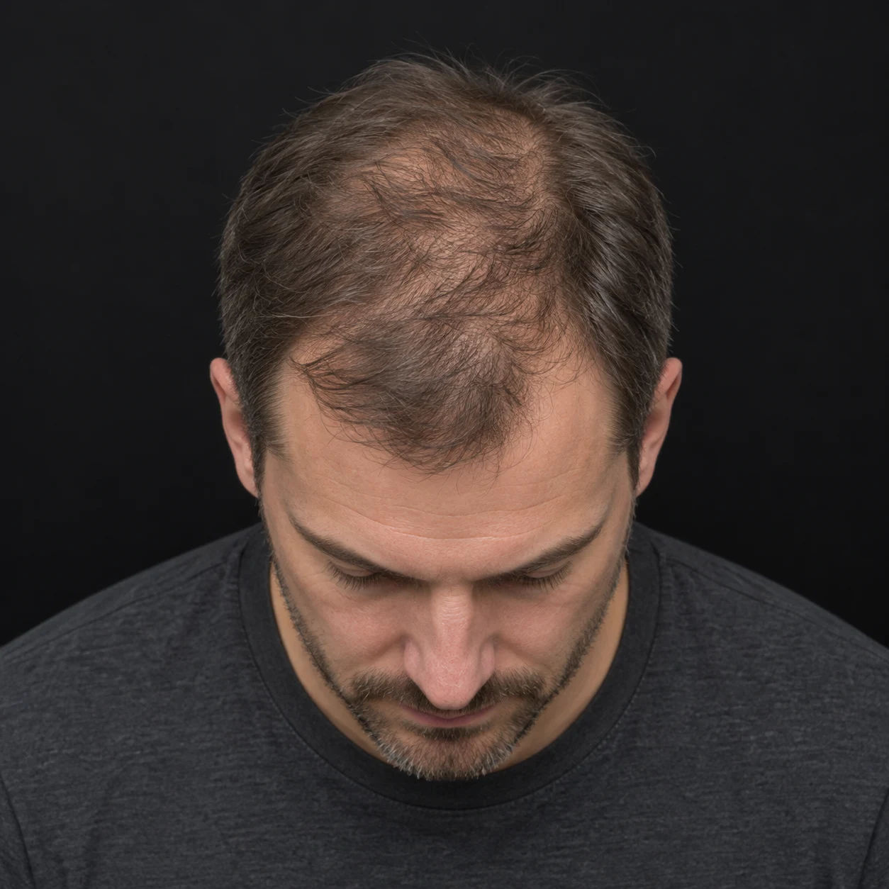 Density SMP for Men with Thinning Hair 2 Teaching illustration of a man with longer retained hair and visible scalp through the thinning top