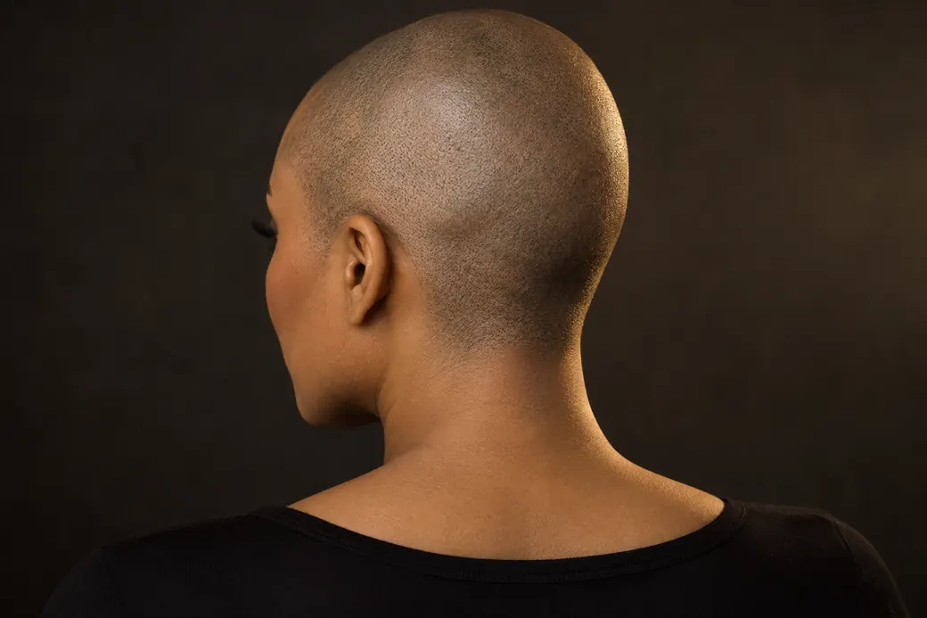 Scalp Micropigmentation for Alopecia: A Guide for Men and Women 2 Illustration showing the sides and nape of a closely shaved scalp