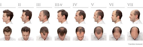 How Much Does Scalp Micropigmentation Cost? 2 norwood scale