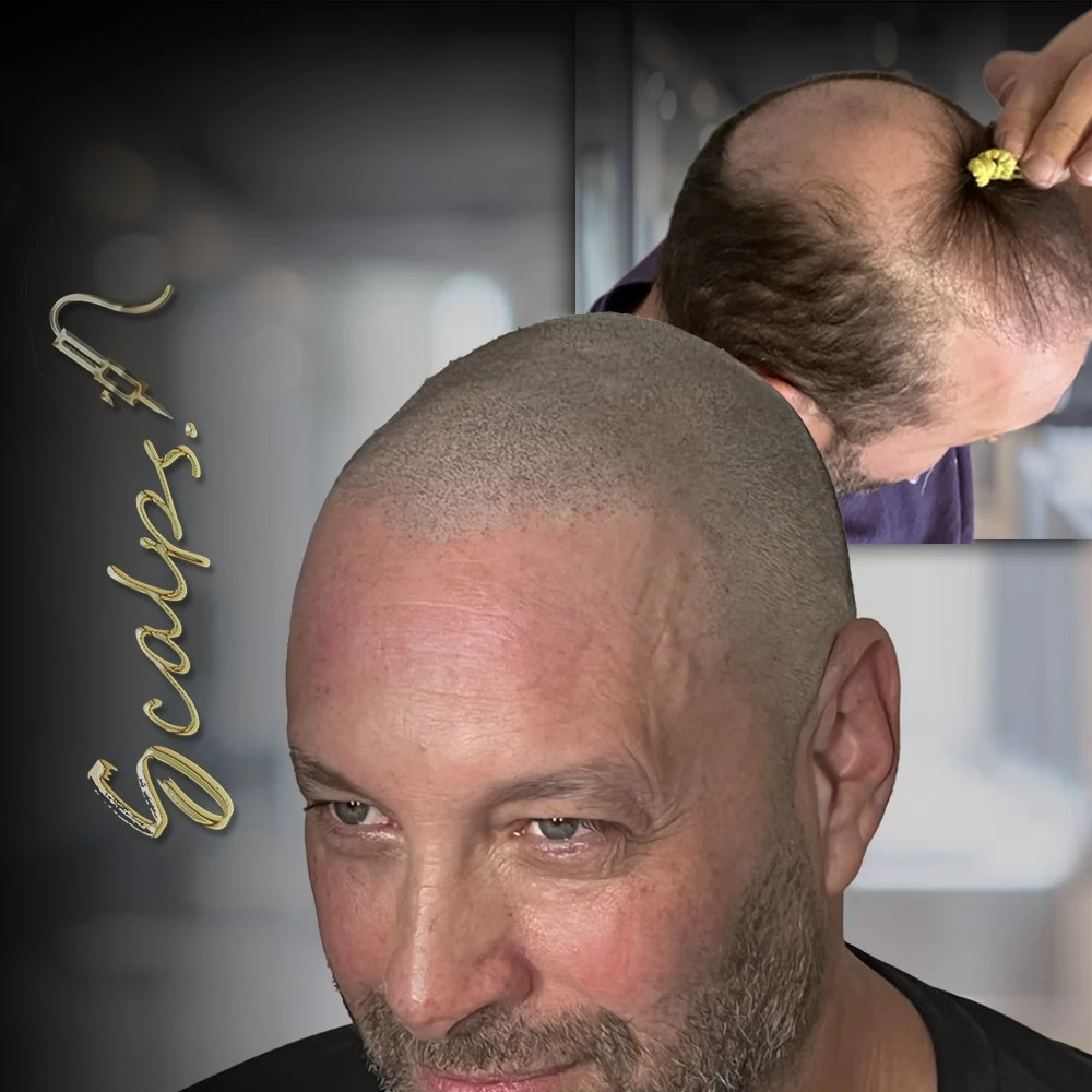 Scalp Micropigmentation For Men | SCALPS 6 Paul Schultz SCALPS